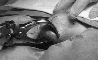 castration
