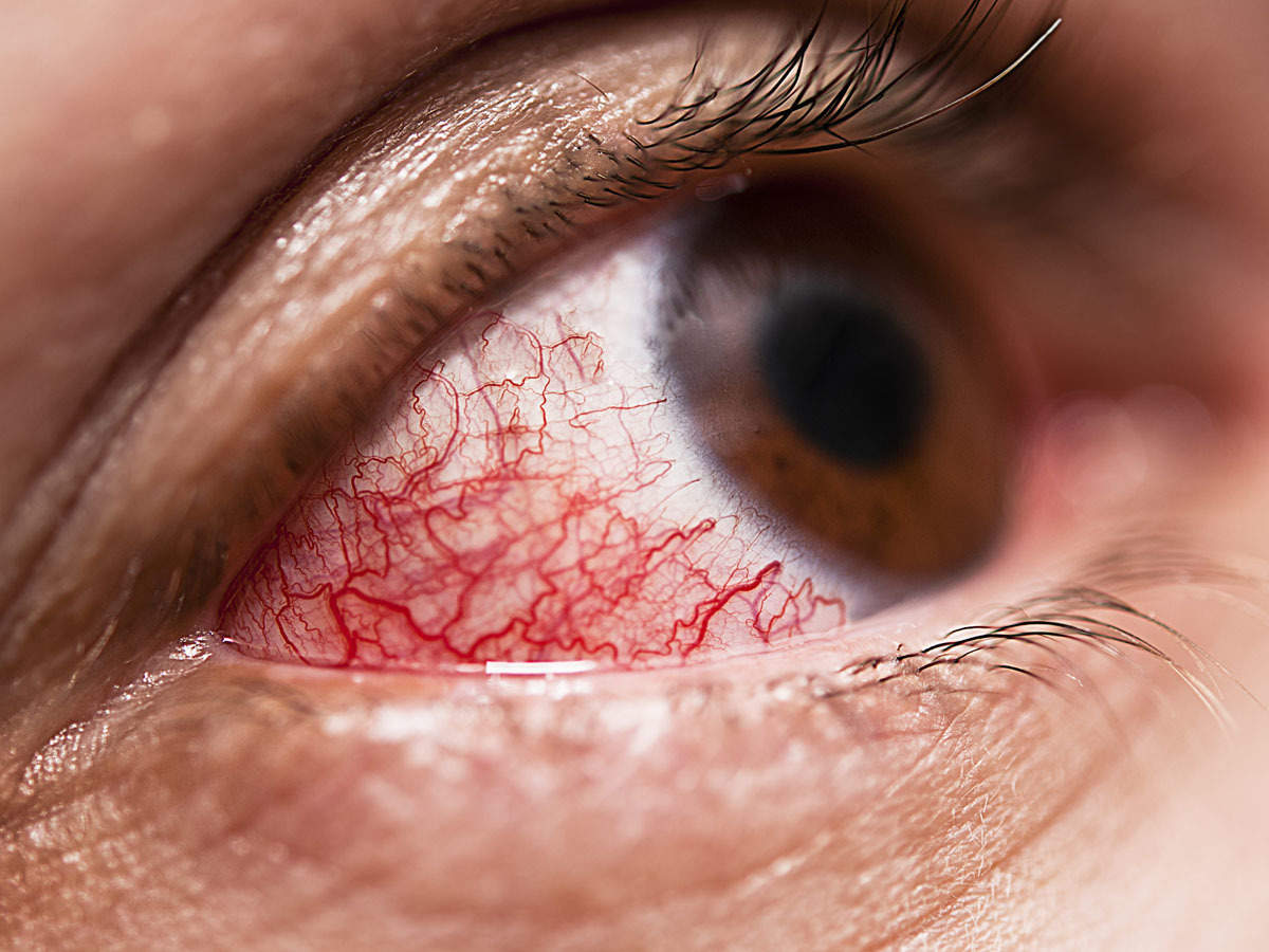 What is Diabetic Eye Disease?