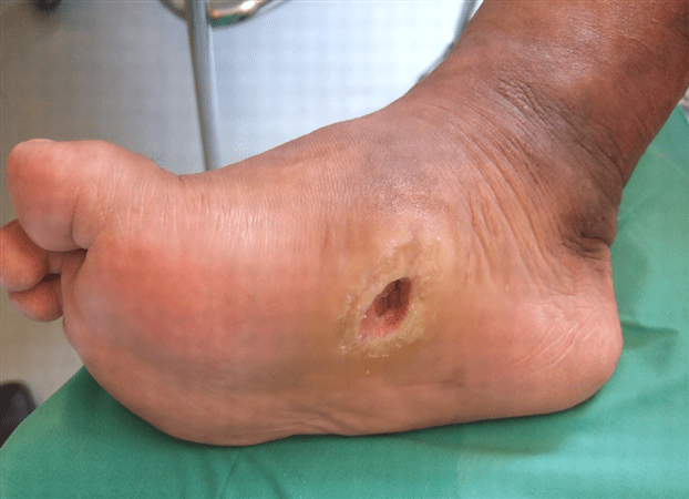 diabetic foot ulcer