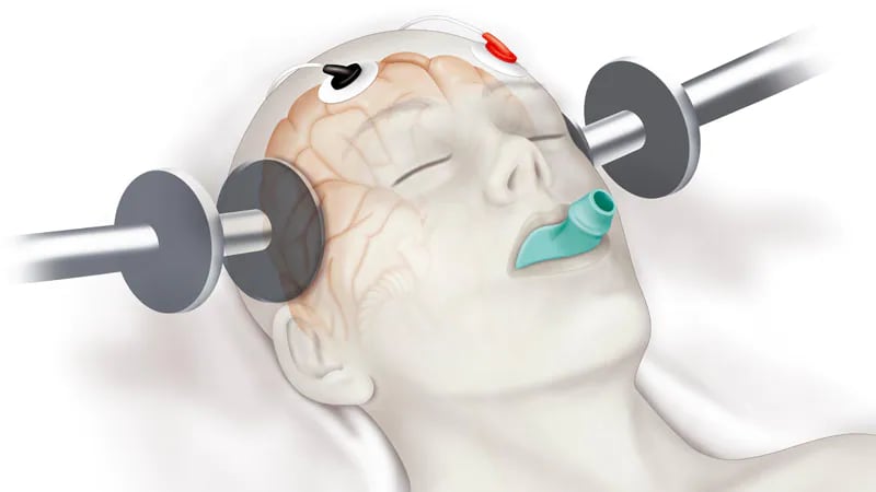 electroconvulsive therapy