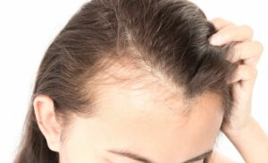 Reduce Hair Fall Naturally: Natural Methods for a Healthy Scalp