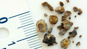 sizeofkidneystone