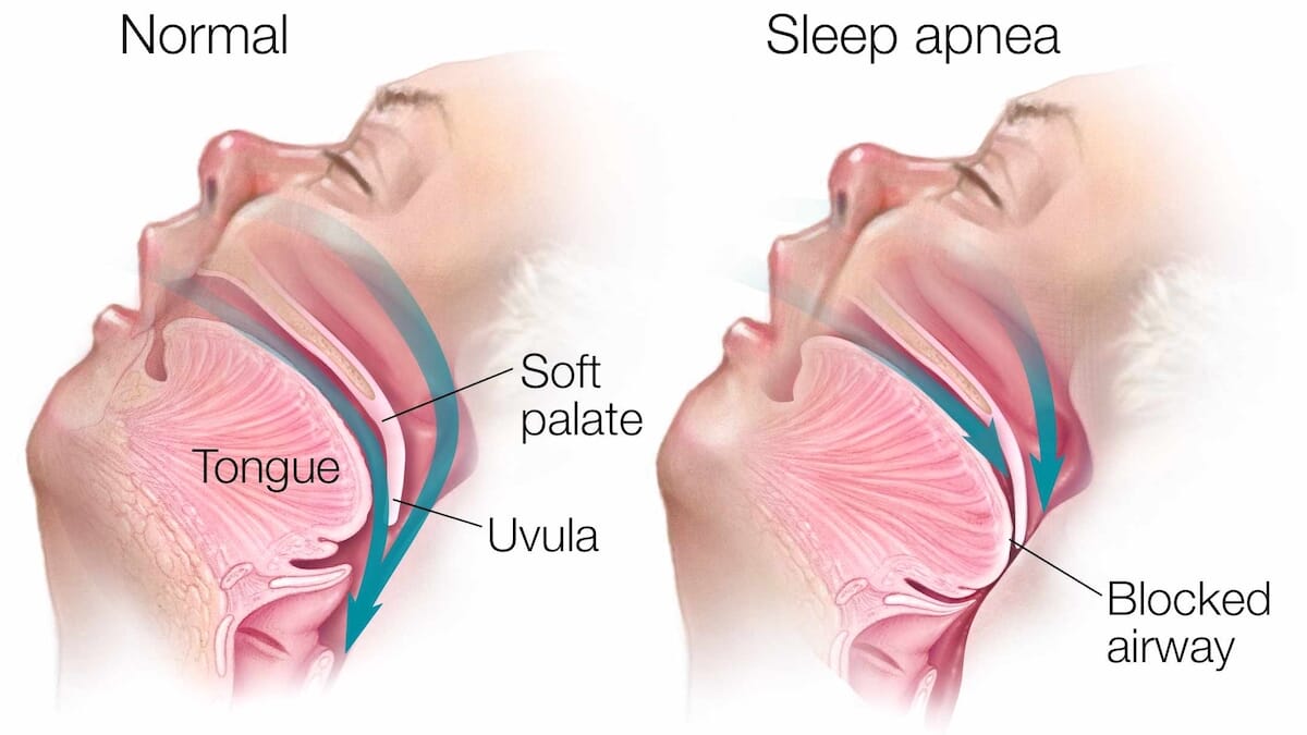 sleepapnea