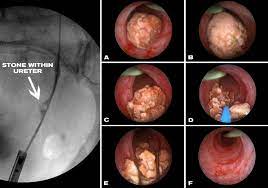 ureteroscoscopy