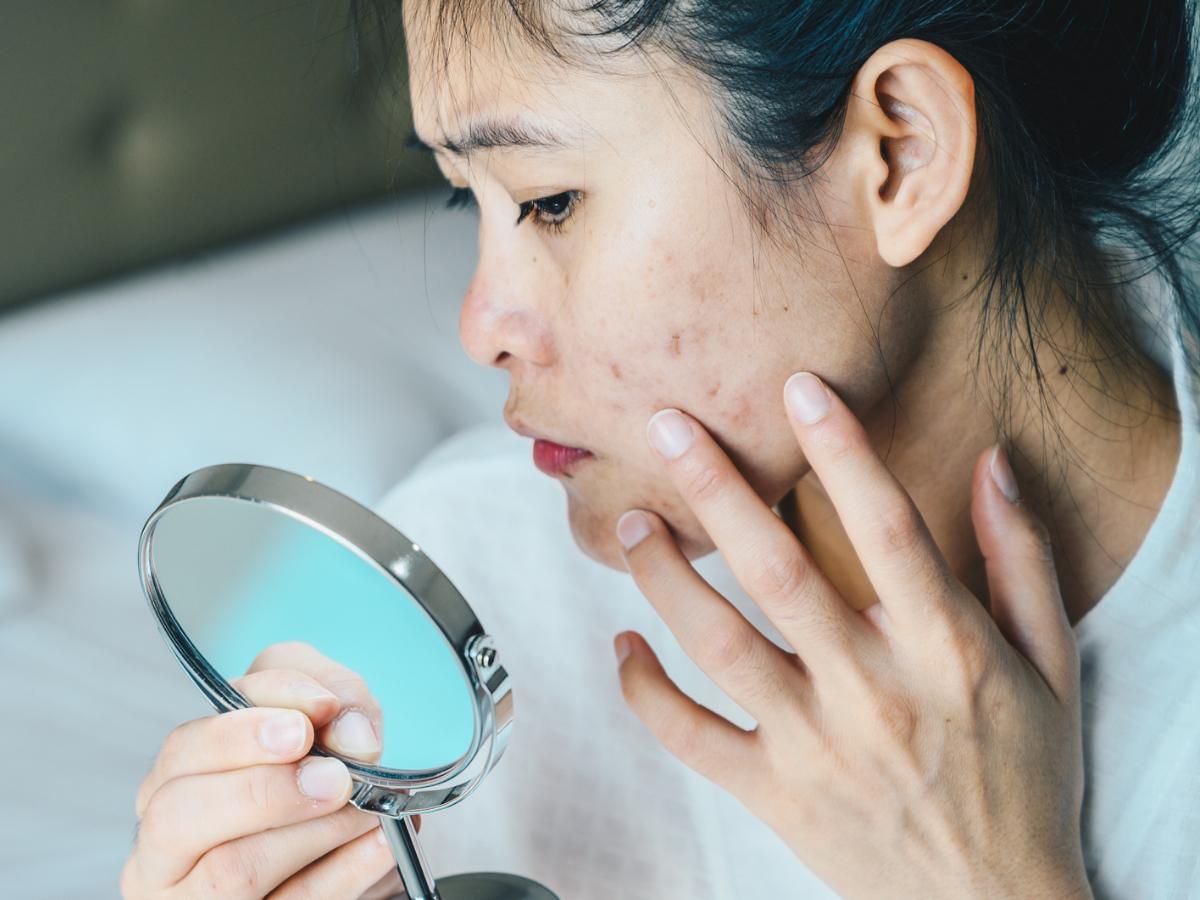 Dermatillomania: Causes, Symptoms & Treatment - Mantra Care