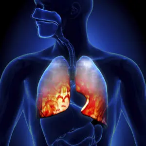 Lung Diseases