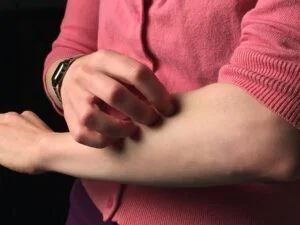 Symptoms of Dermatillomania