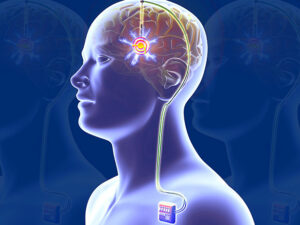 Transcranial Stimulation Therapy