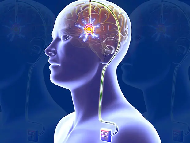 Transcranial Stimulation Therapy