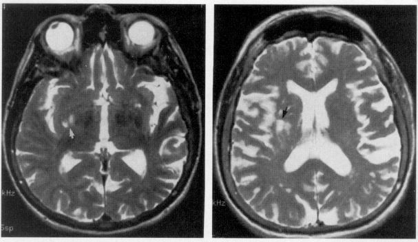 anosognosia brain scan