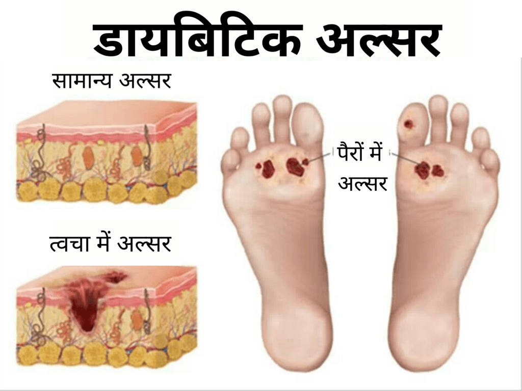 डायबिटिक अल्सर