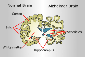 What Is Alzheimer's Disease?