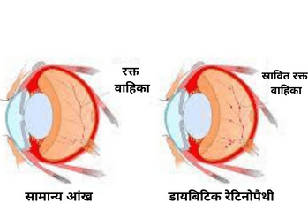 डायबिटिक रेटिनोपैथी