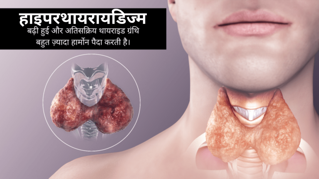हाइपरथायरायडिज्म क्या है