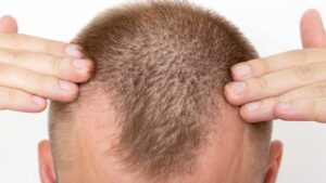 What Are The Complications Of Trichotillomania OCD
