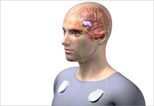 OCD Brain Surgery