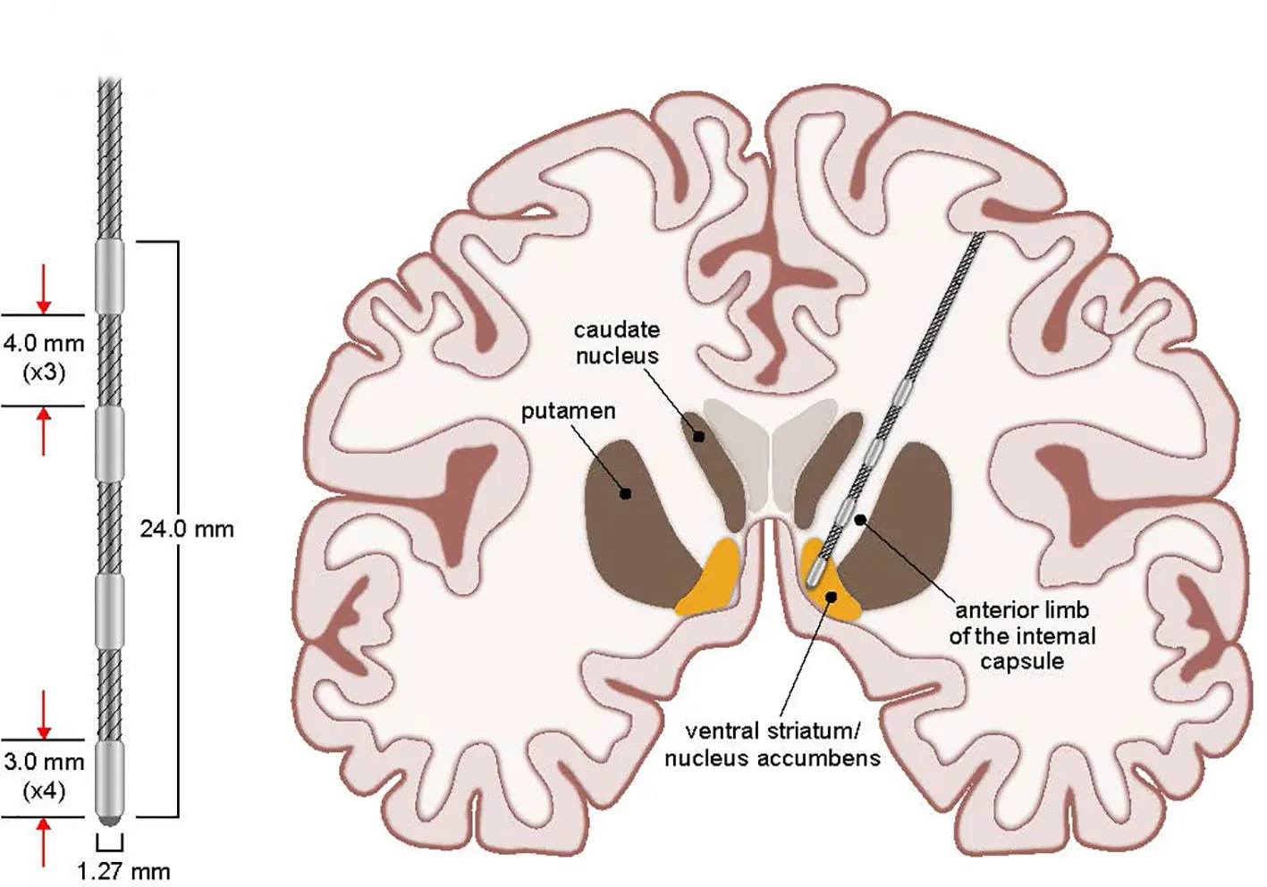 OCD Brain Surgery