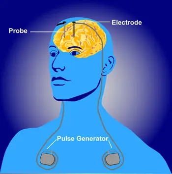OCD Brain Surgery