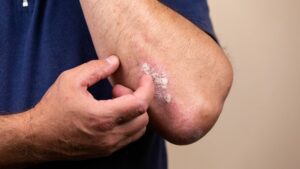 What Is Excoriation Disorder (1)