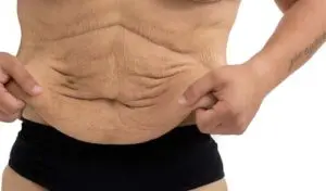 17 Steps to Reduce Loose Skin After Weight Loss