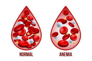 Defining Anemia