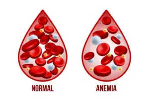 Defining Anemia