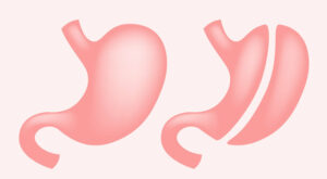 Gastric Sleeve Weight Loss Surgery