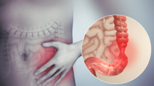Gut Disorder
