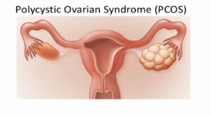 PCOS