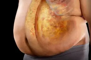 Visceral Fat