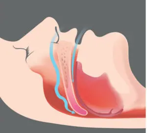 breathing-issues