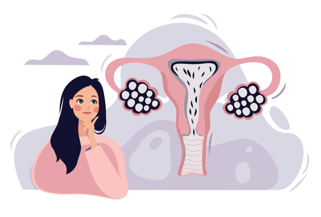 What Is PCOS?