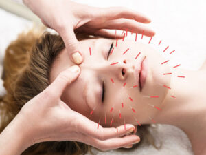 Acupuncture is beneficial for stress and anxiety
