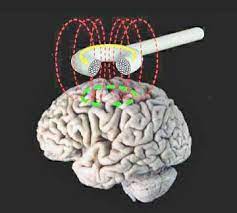 Transcranial magnetic stimulation (TMS)