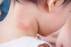 Rashes