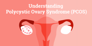 Understanding PCOS
