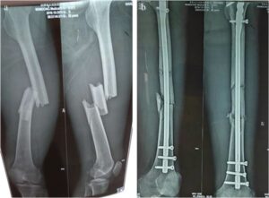 Surgical Treatment For Femur Fracture
