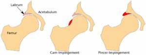 What Is Hip Impingement?