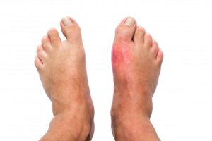 Symptoms Of Neuropathy In Legs and Feet