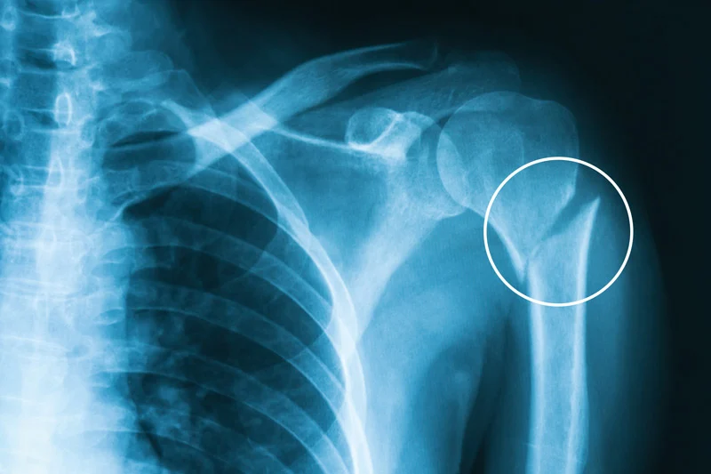 Proximal Humerus Fracture: Symptoms, Causes, and Treatment