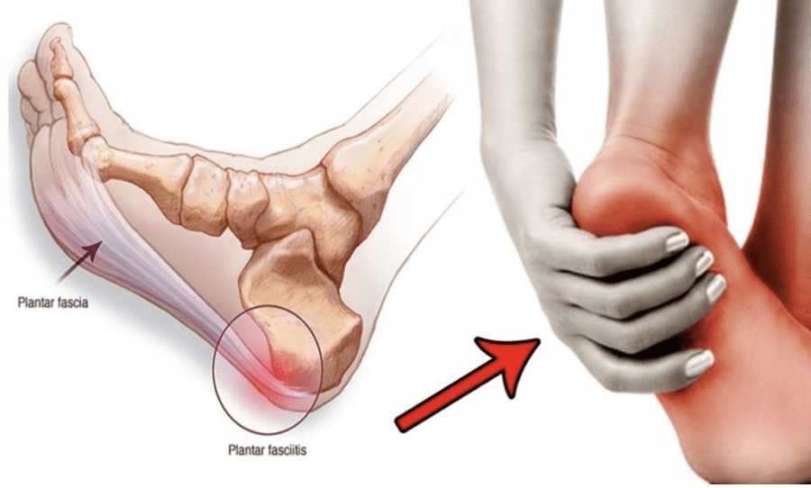 Plantar Fasciitis: How Can You Treat It