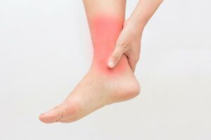 What Is Ankle Sprain?