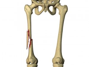 Femur Fracture
