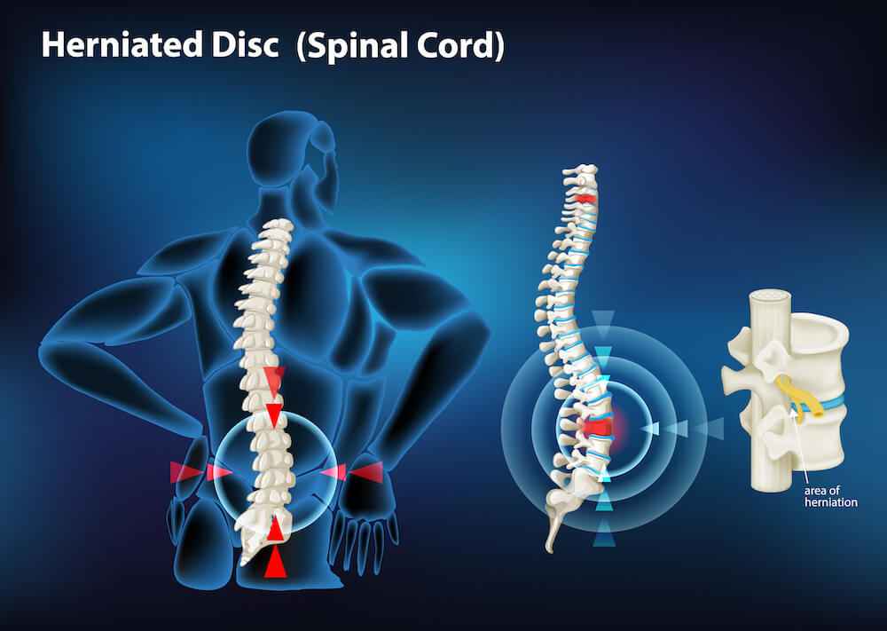 Struggling With a Herniated Disc? Physical Therapy May Be the Answer