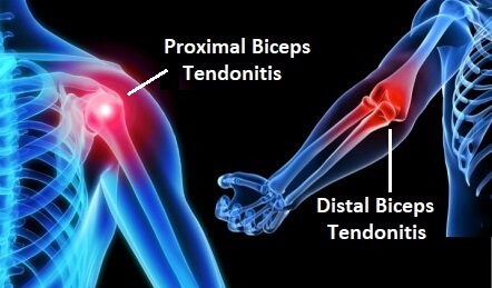 Torn Biceps Tendon: Causes, Symptoms, and Treatment