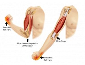 What Is Cubital Tunnel Syndrome?