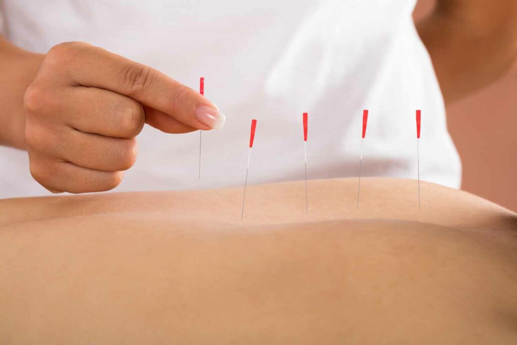 Dry Needling: Everything You Need to Know