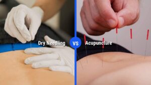 What Is The Main Difference Between Acupuncture And Dry Needling?