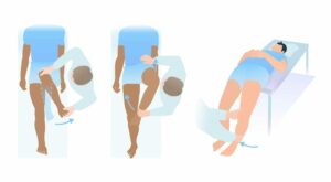How To Diagnose Hip Impingement?