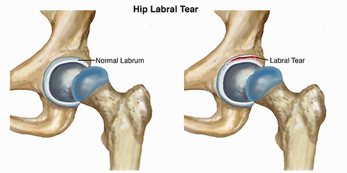 Why You Should Know About Labral Tears in Your Hip